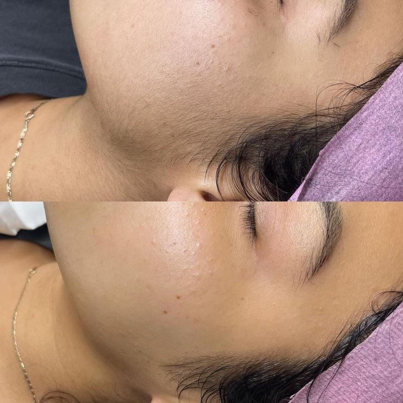 DermaplanePro Before After