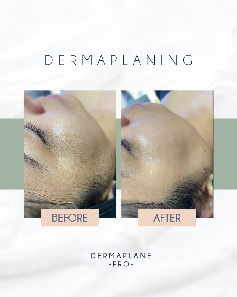 DermaplanePro Before After 2