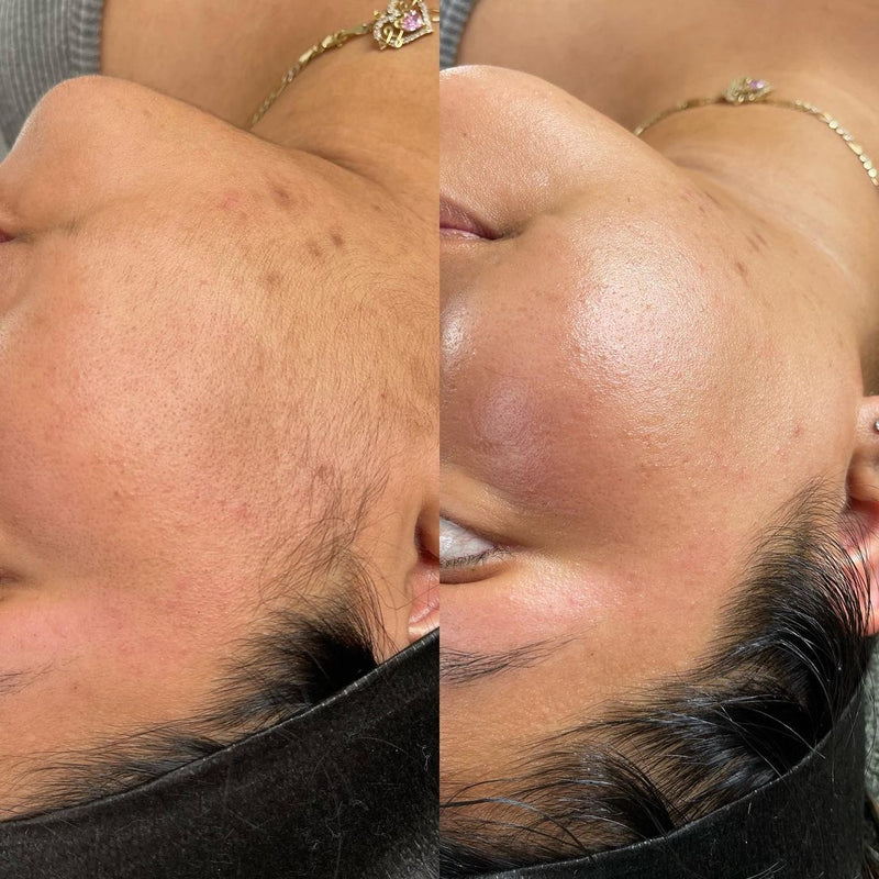 DermaplanePro Before After 3