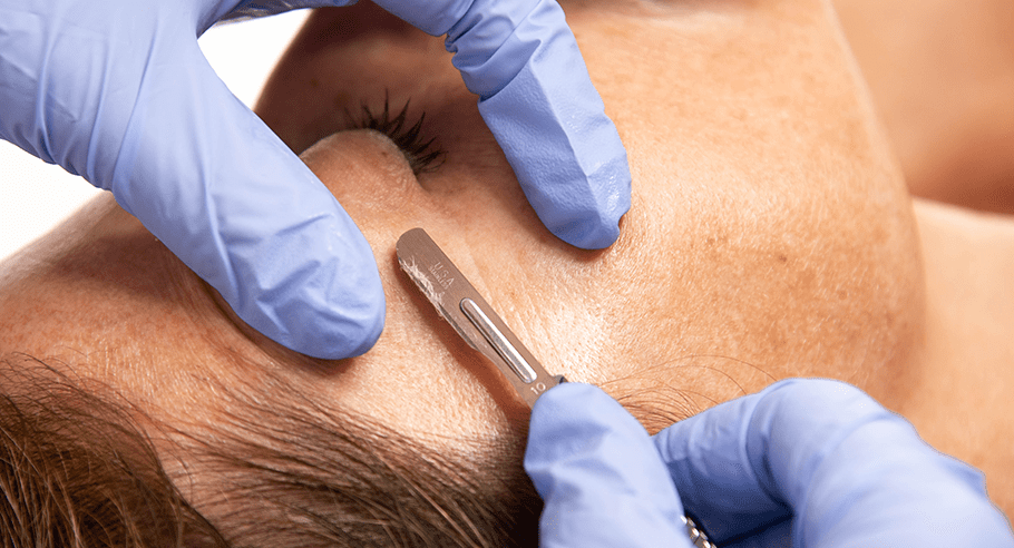 Hands wearing blue latex gloves use a #10 blade to Dermaplane the temple of another person. Old skin and vellus hair is visible on the blade.