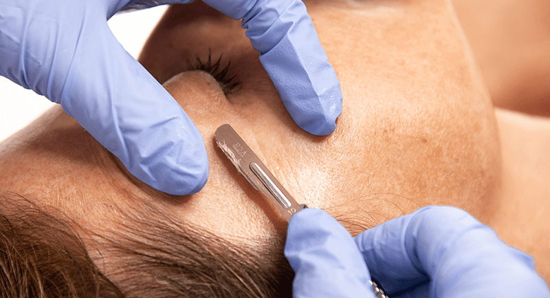 Hands wearing blue latex gloves use a #10 blade to Dermaplane the temple of another person. Old skin and vellus hair is visible on the blade.