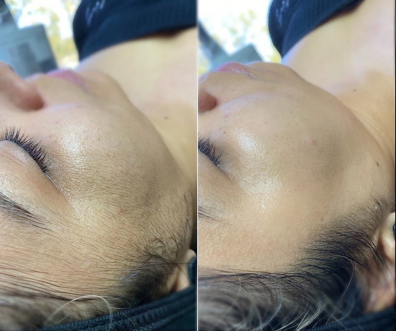 Side by side shot of a person's temple and cheek bone before and after being dermaplaned.